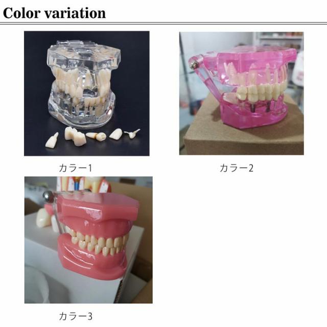 歯模型 透明 歯の模型 歯列模型 疾患展示模型 歯科模型 差し歯 歯医者