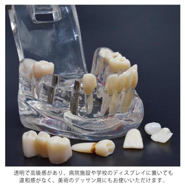 歯模型 透明 歯の模型 歯列模型 疾患展示模型 歯科模型 差し歯 歯医者