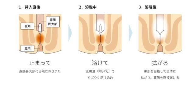 ボラギノールM坐剤