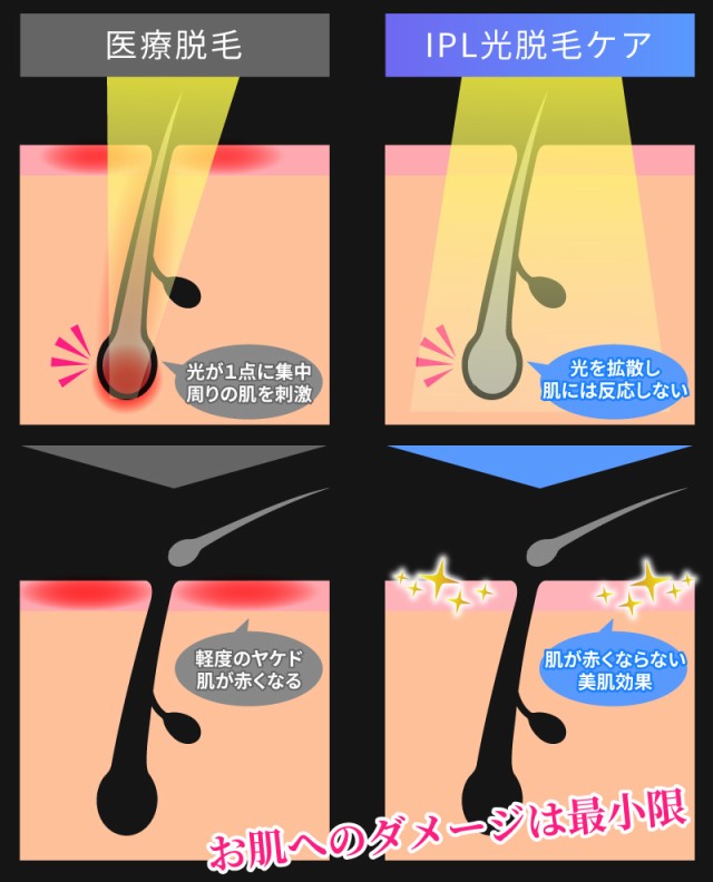 脱毛器 脱毛器レーザー 脱毛器 vio 脱毛器人気 脱毛器フラッシュ 脱毛器具 脱毛器男性 IPL ipl光脱毛器 冷却 ipl脱毛器 家庭用脱毛器 VIO - 0