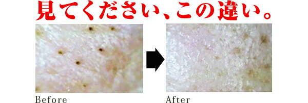 キョンセーム美鼻マスク(ミビマスク)の使用で、見て下さい、この違い。