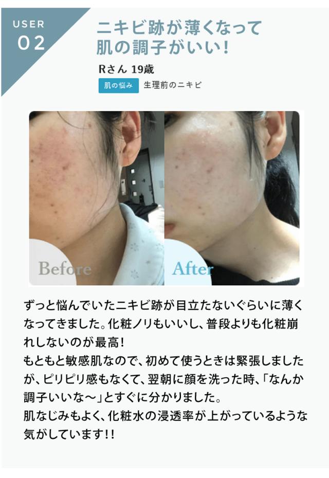 送料無料/正規品】redeal. リディアル RDセラム 30ml 美容液 アクネ