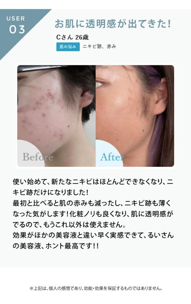 redeal. リディアル RD アクネトリートメントセラム 正規販売店】redeal. リディアル RDセラム 30ml 美容液 アクネ