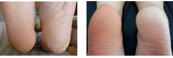 スベスベかかと