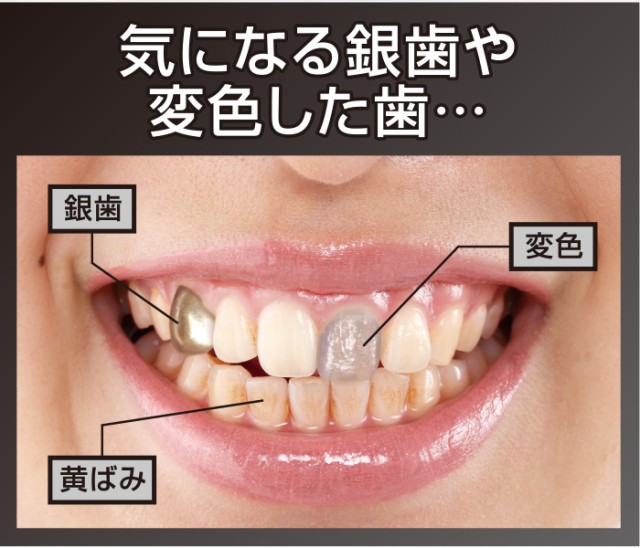 気になる銀歯や変色した歯